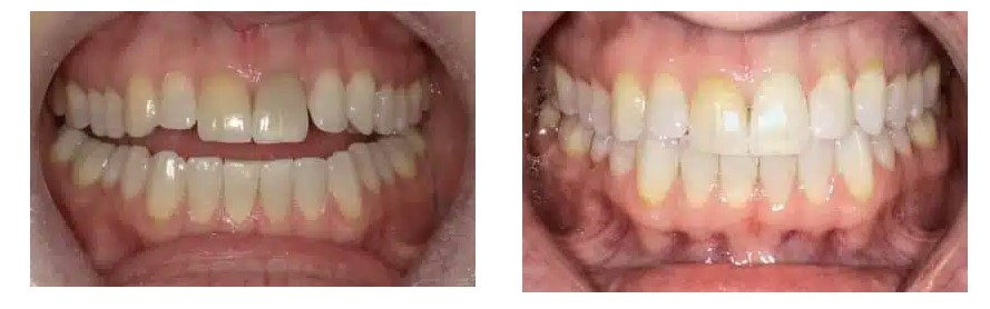 Before and after view of BioClear treatment addressing a darkened front tooth and spacing