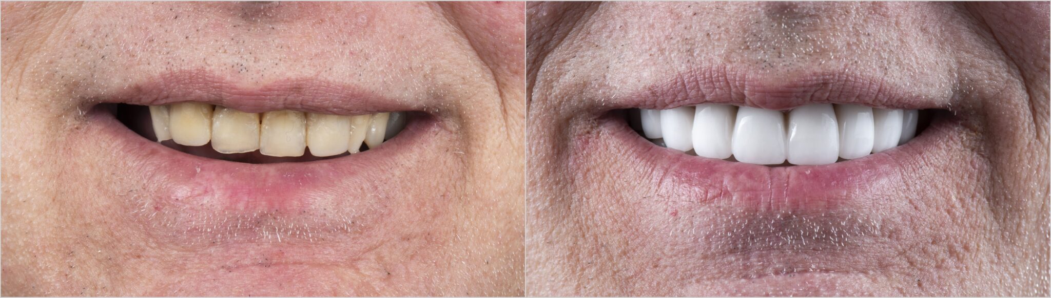 Natural-looking smile representing custom dental veneer treatment