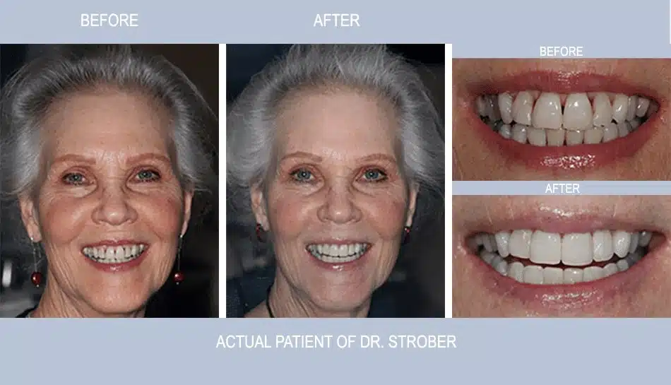 BioClear cosmetic dentistry example at Country Club Dentistry