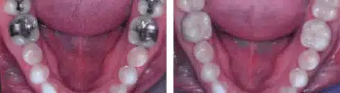 Examples of tooth-colored CEREC crowns, inlays and onlays