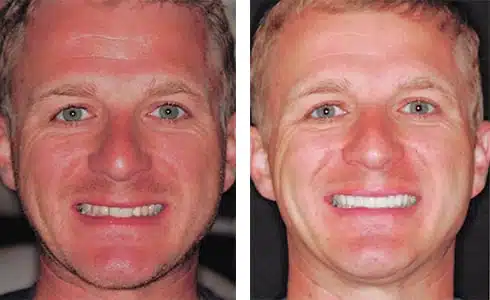 CEREC dental crown ceramic restoration showcase