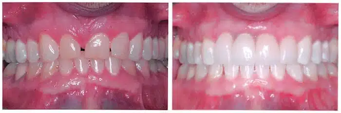 Cosmetic dentistry smile transformation example