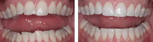 Dental bonding before and after showing a conservative cosmetic tooth repair