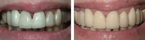 Dental bridge before and after treatment