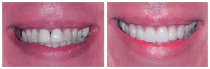 Dental veneers before and after treatment by Dr. Rod Strober
