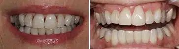 BioClear before and after cosmetic tooth reshaping