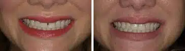 BioClear before and after black triangle closure